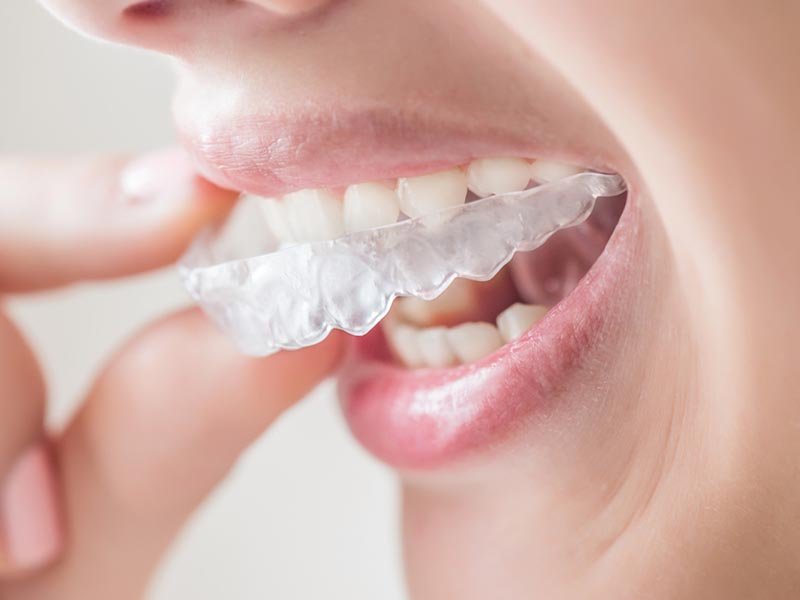 invisalign clear aligner system image