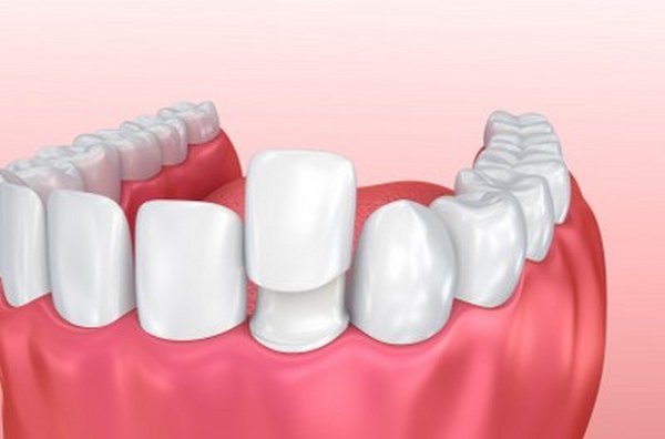 porcelain dental veneers