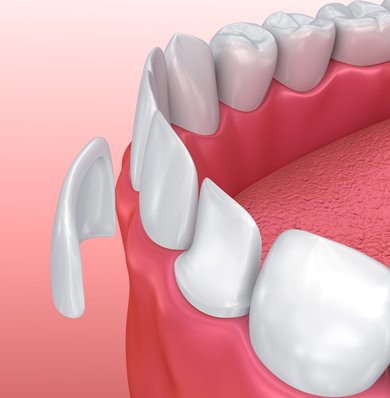 Porcelain Veneers, BENEFITS, PROCEDURE, COSTS, AND RESULTS
