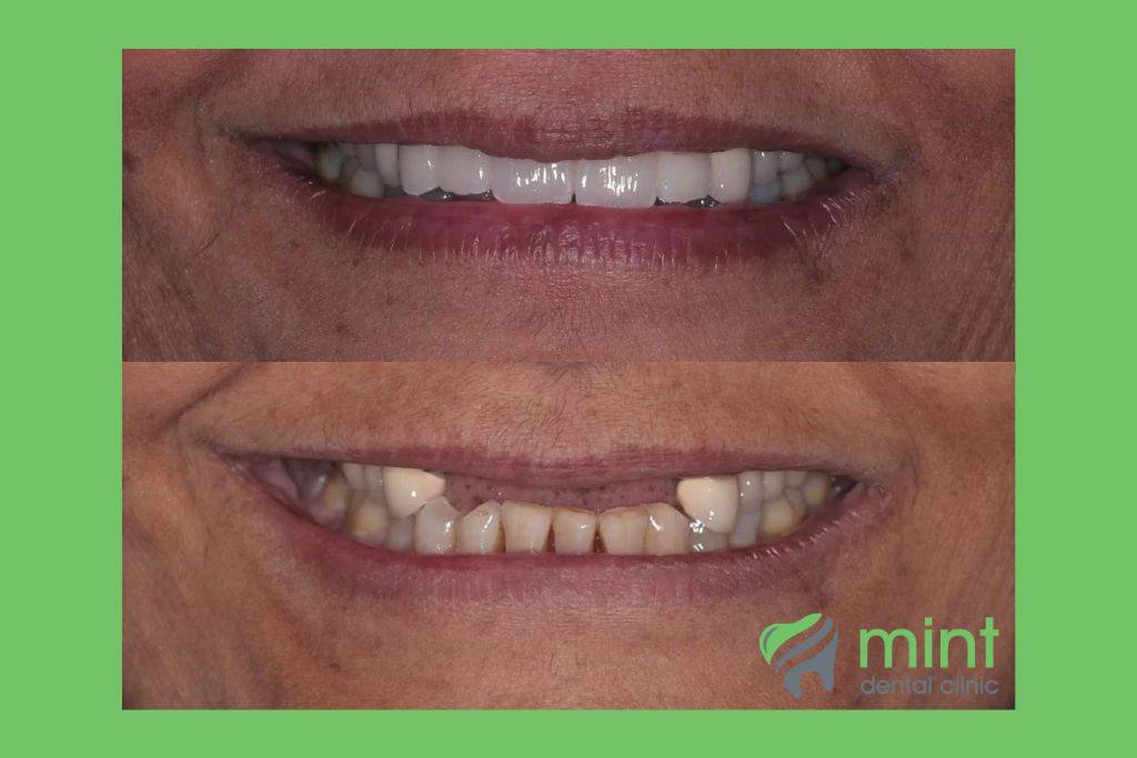 before and after image of implants