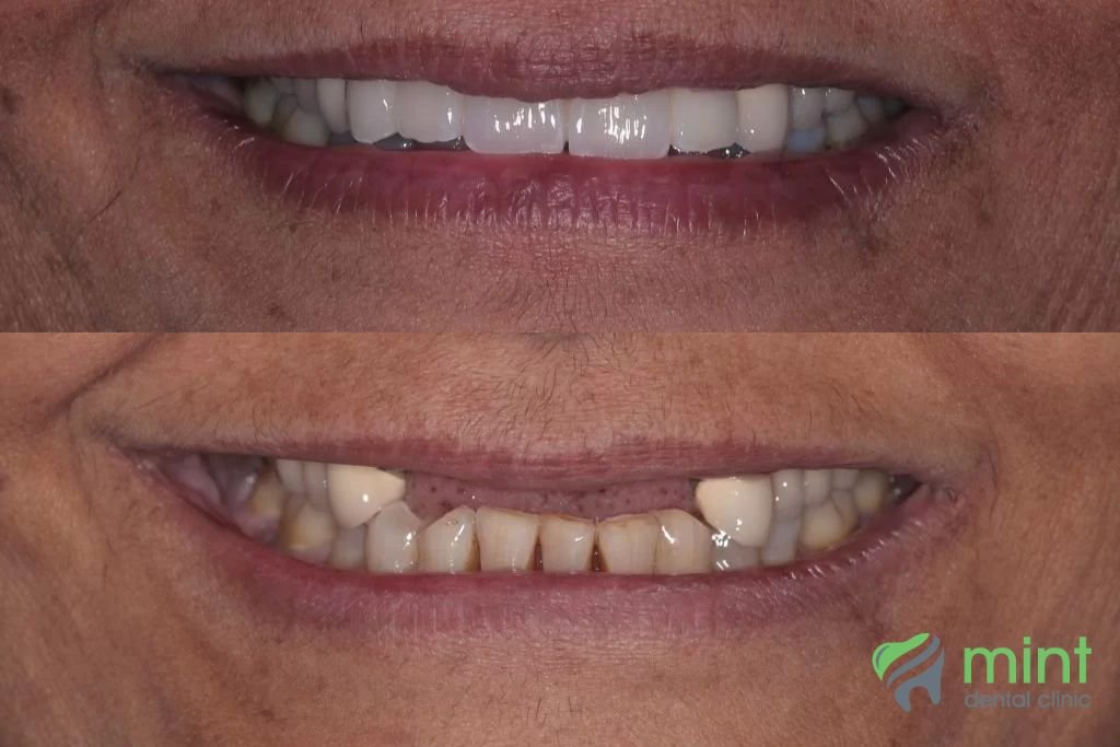 dental implant before and after photo