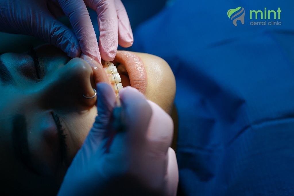 lingual braces removal