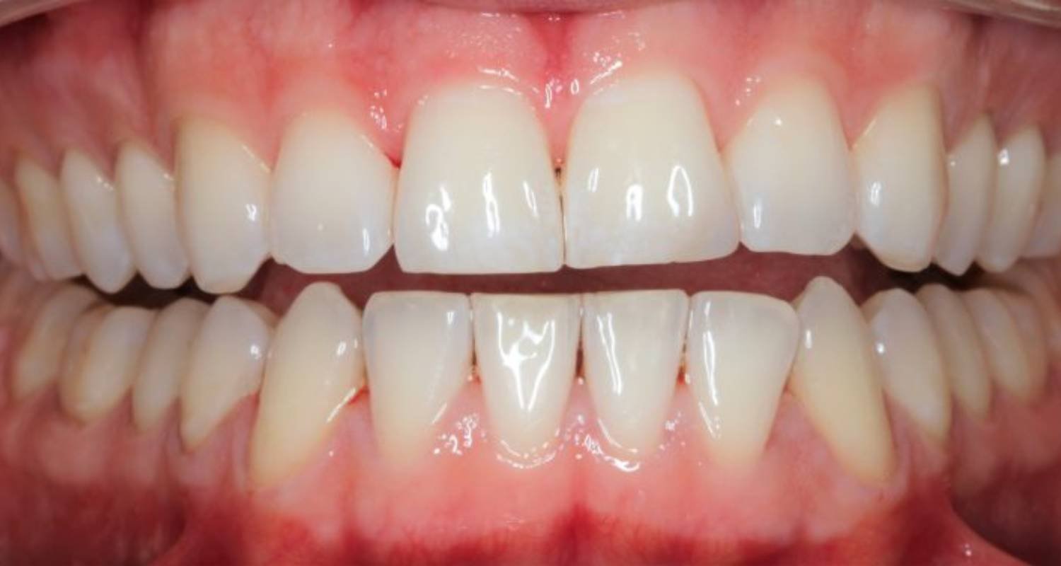 after hygiene appointment