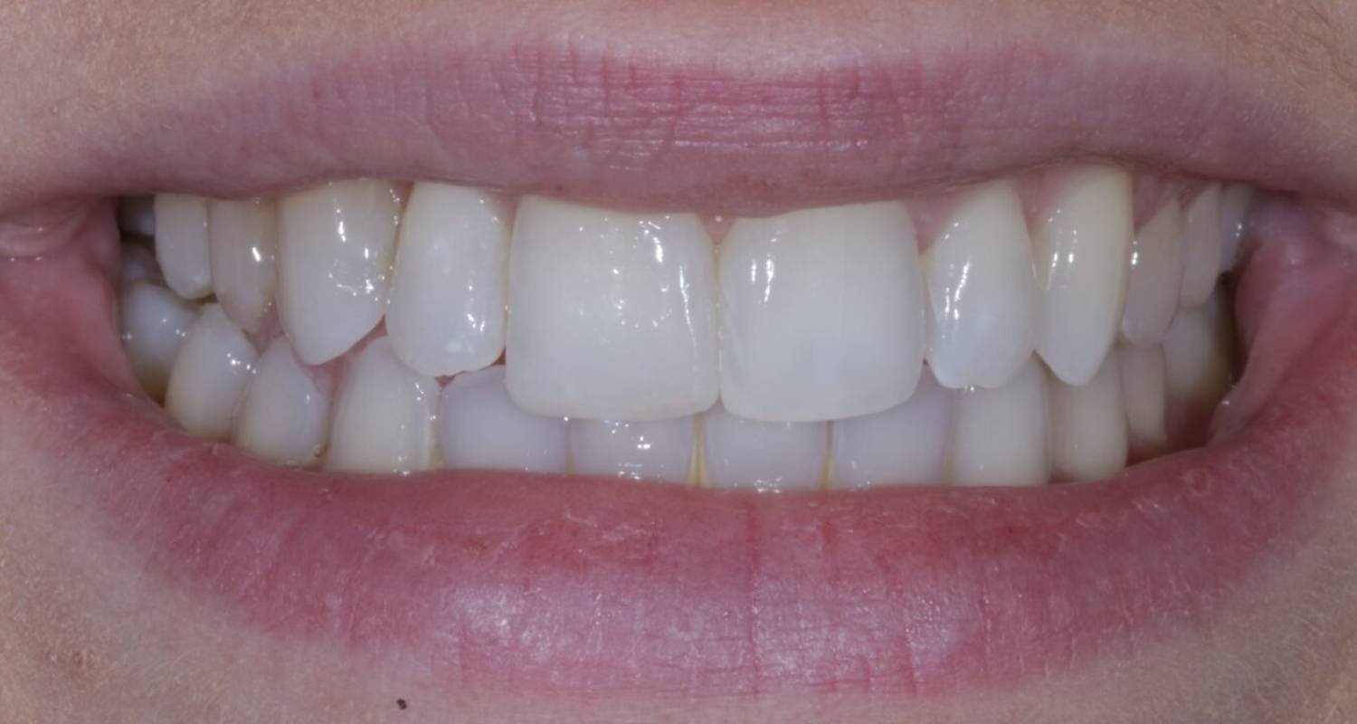 after invisalign image