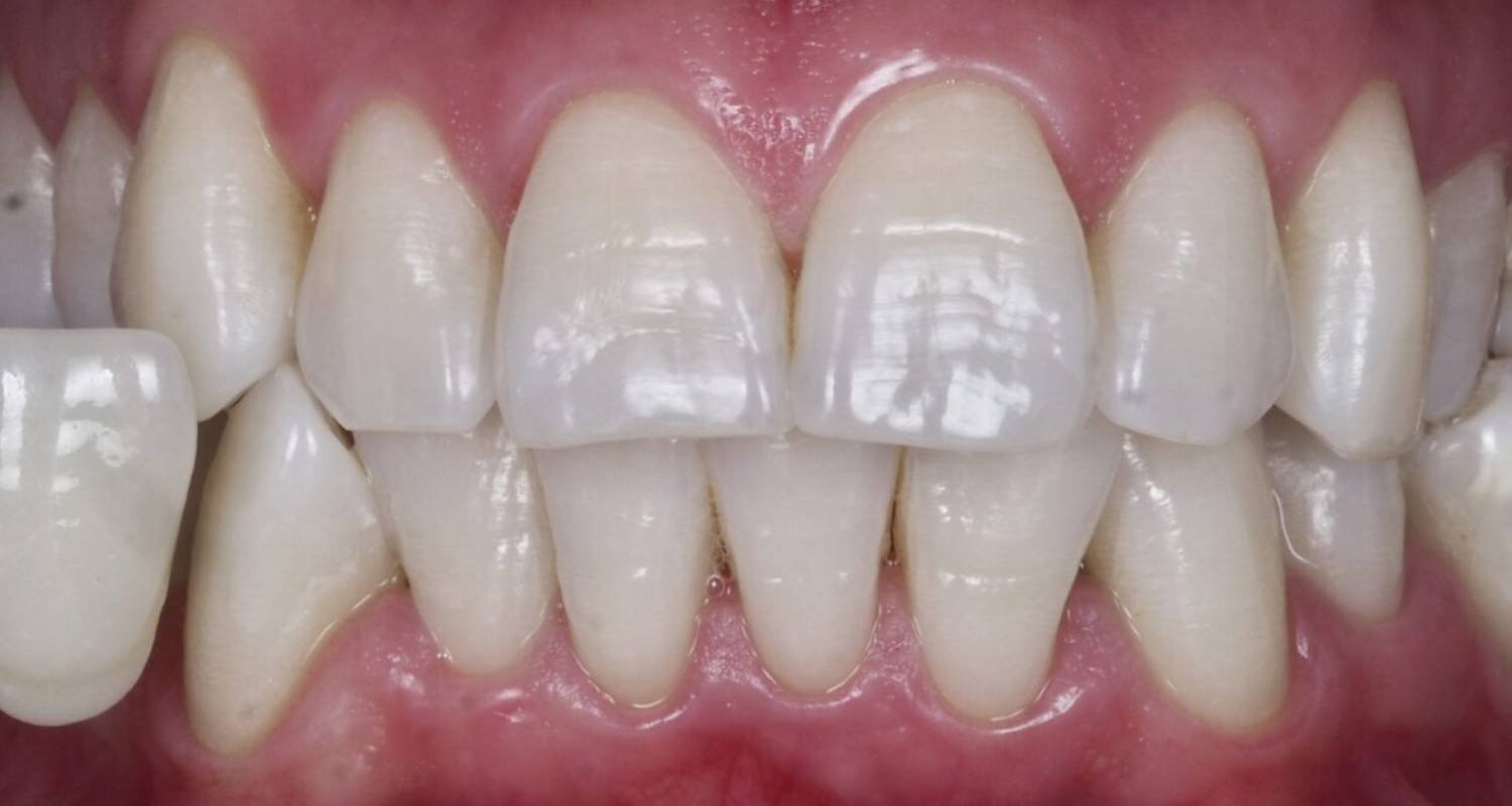 after tooth whitening