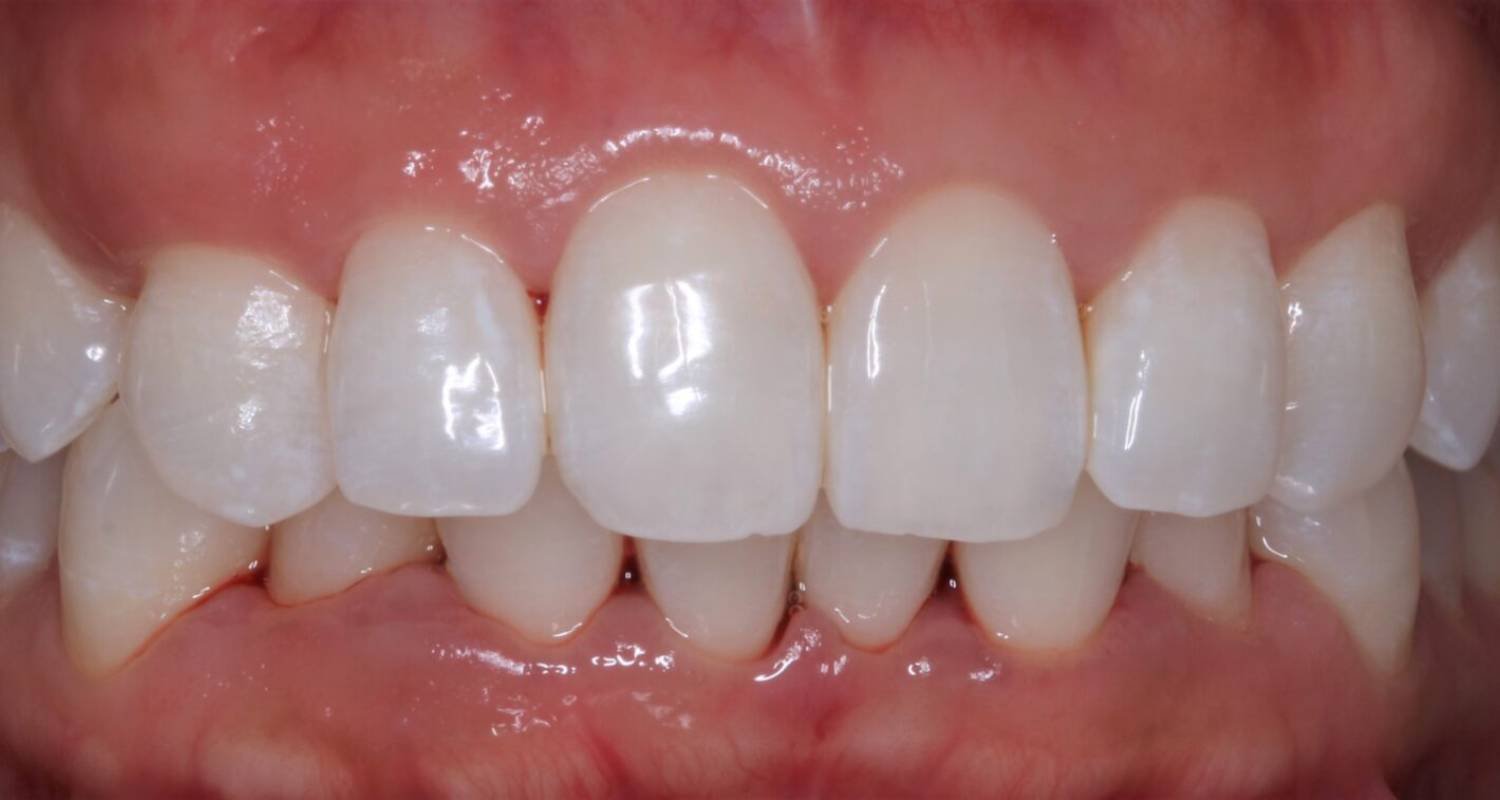 after whitening