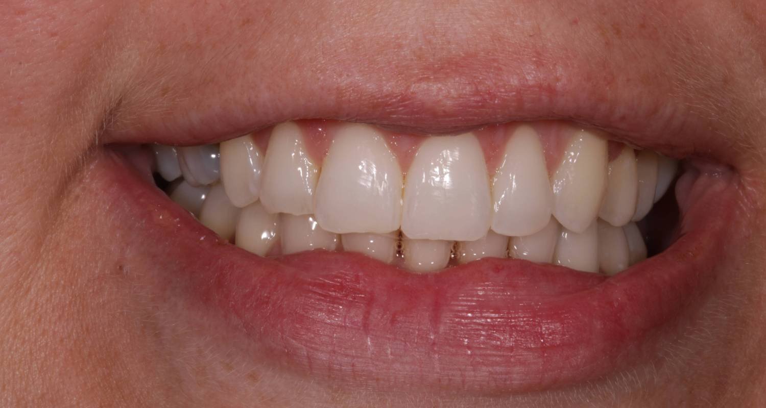 before composite bonding