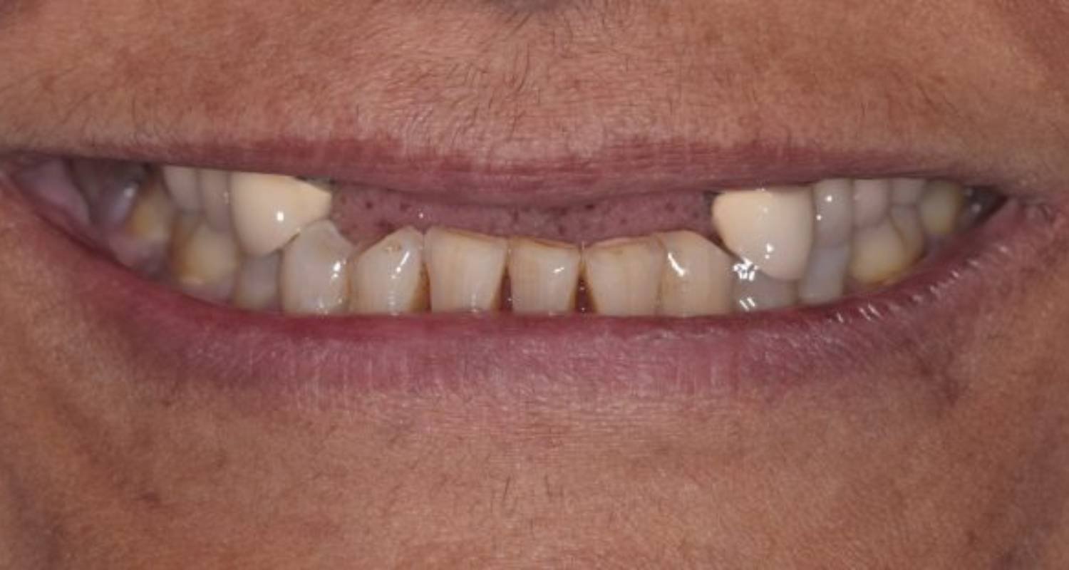 before dental implants image