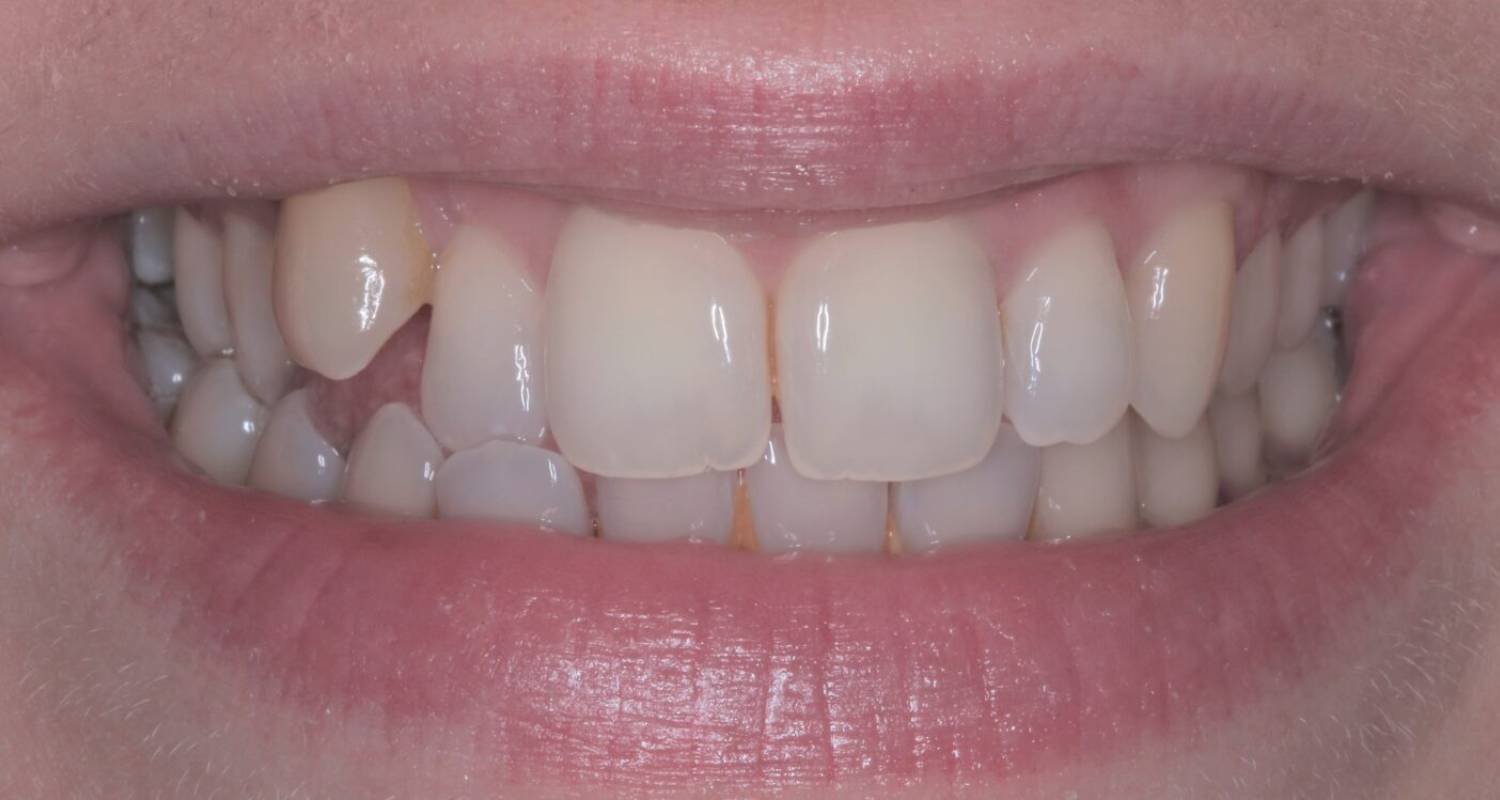 before invisalign image