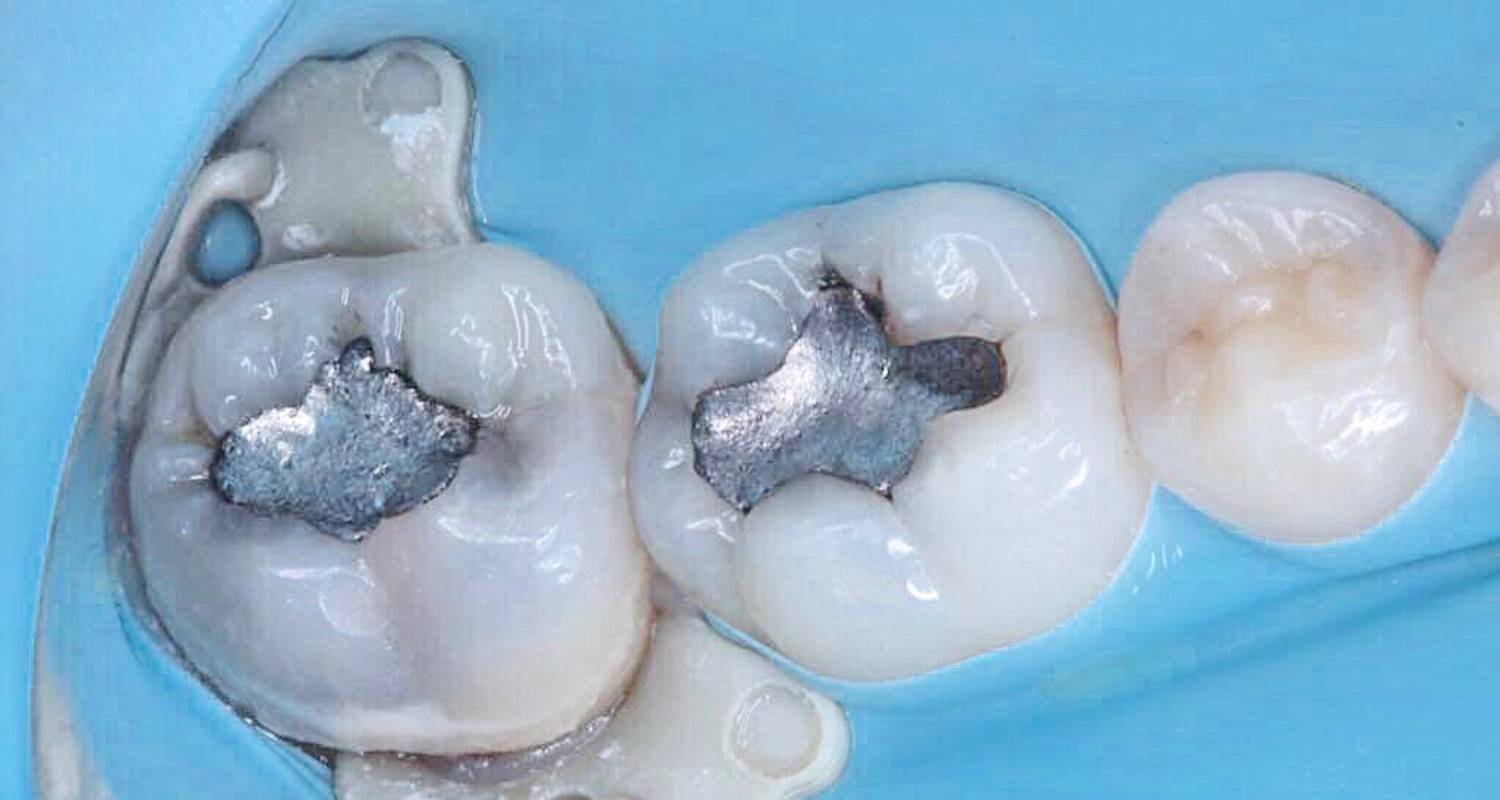 before metal filling image