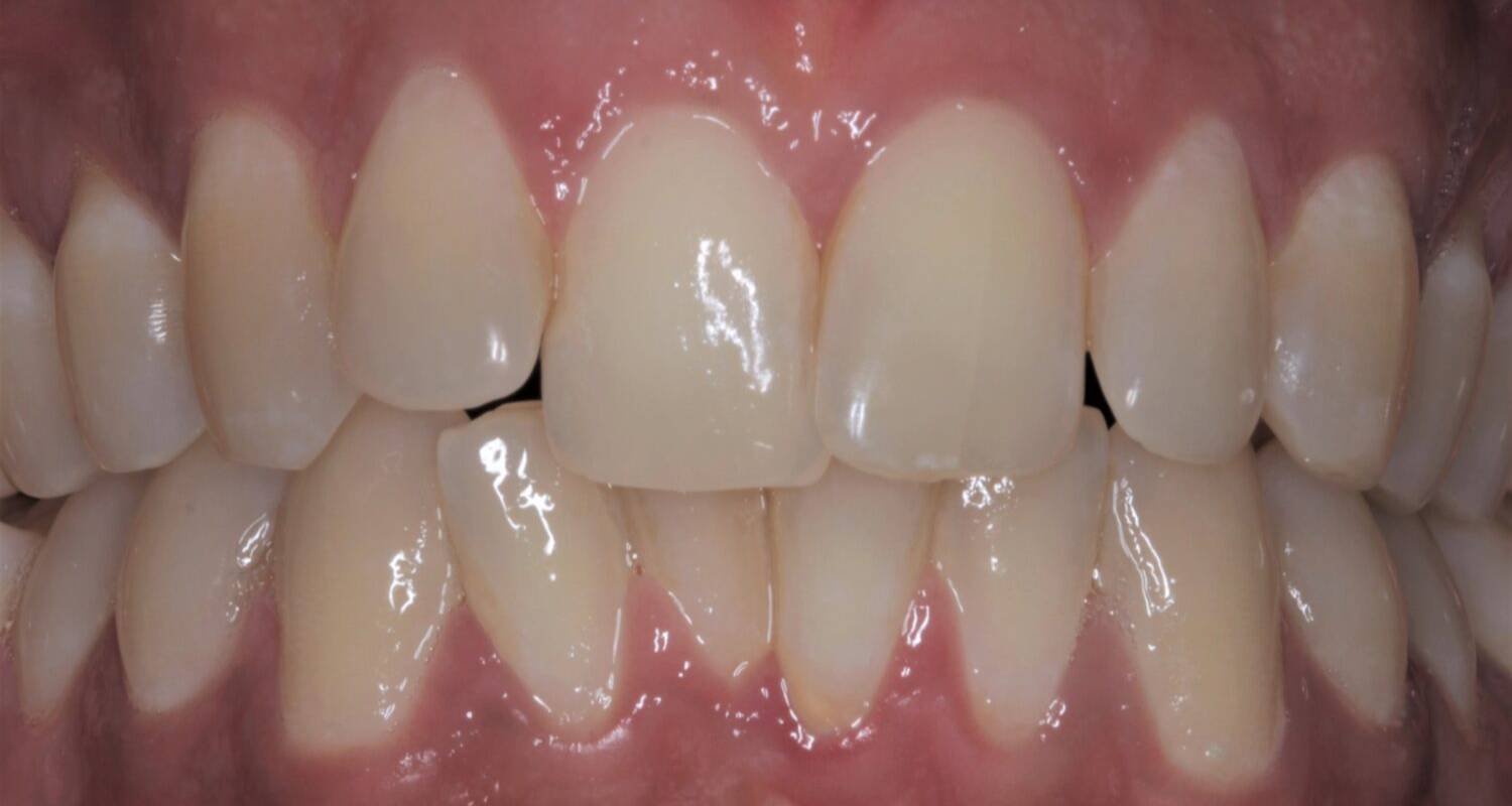 before tooth whitening treatment