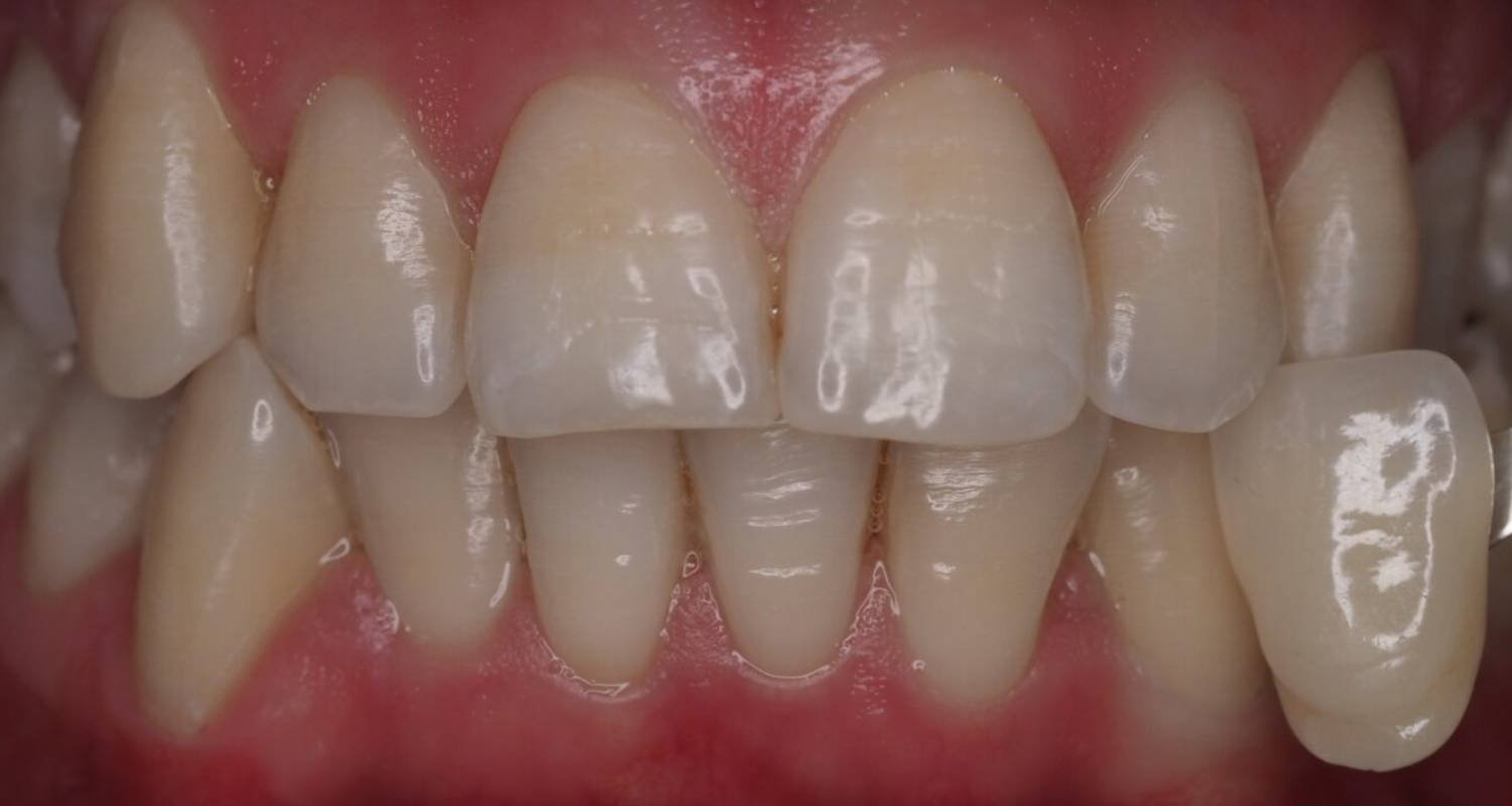 before tooth whitening