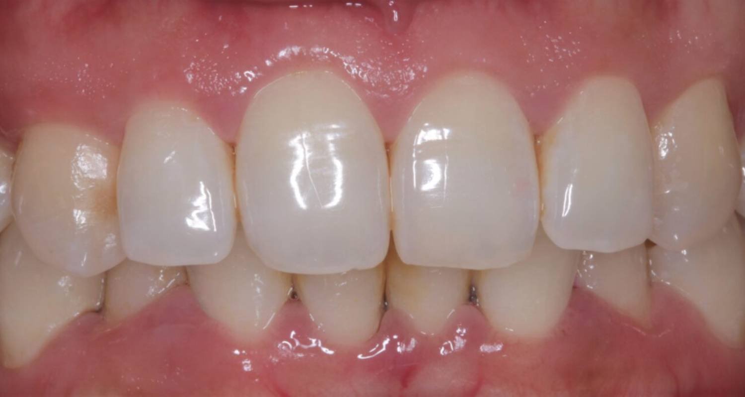 before whitening