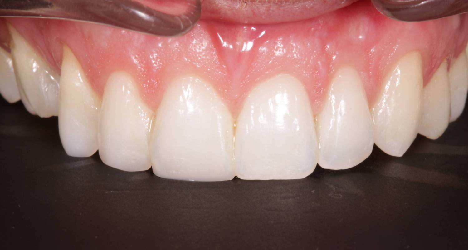 composite bonding after