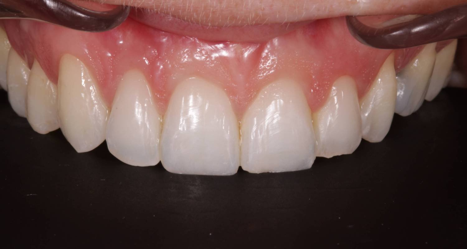 composite bonding before