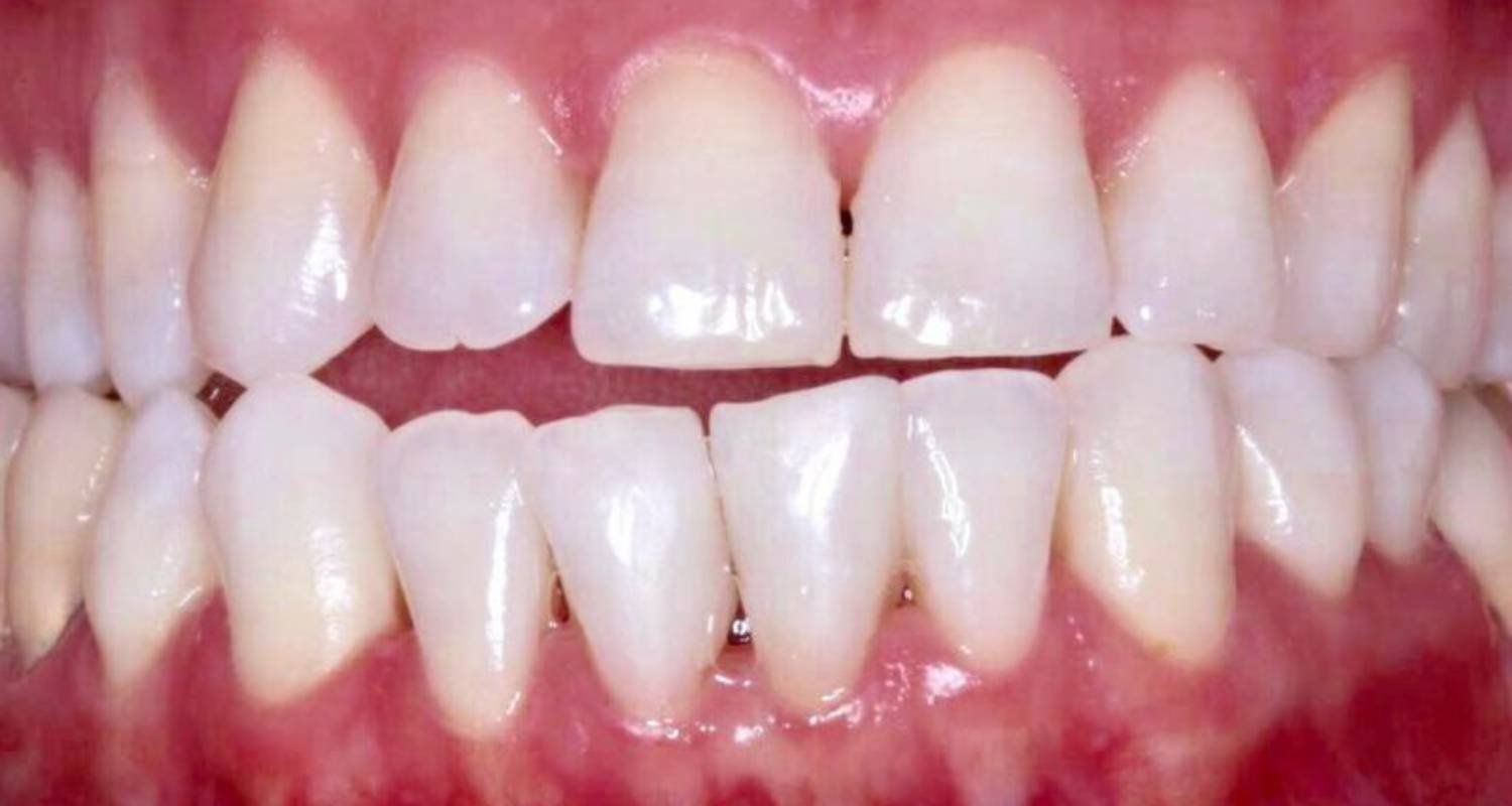 gapped teeth after treatment