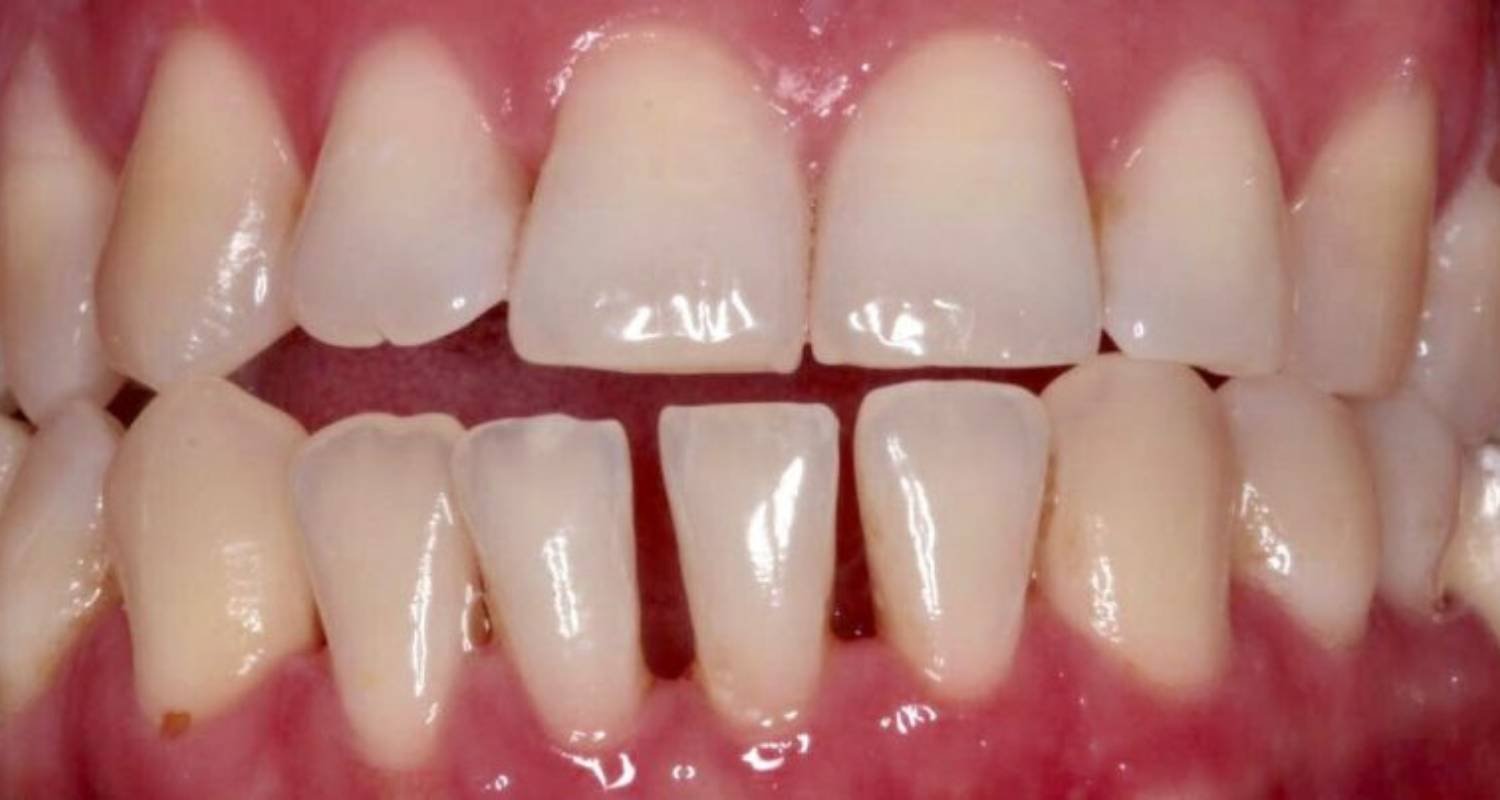 gapped teeth before treatment