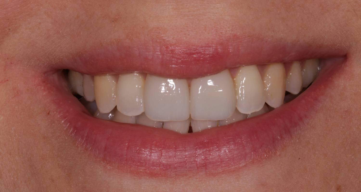 invialign for overbite after