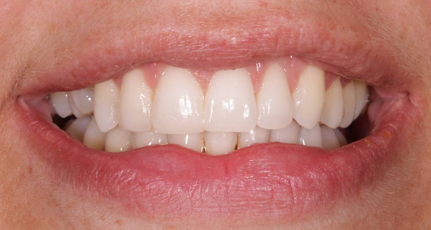 invisalign for crooked teeth after