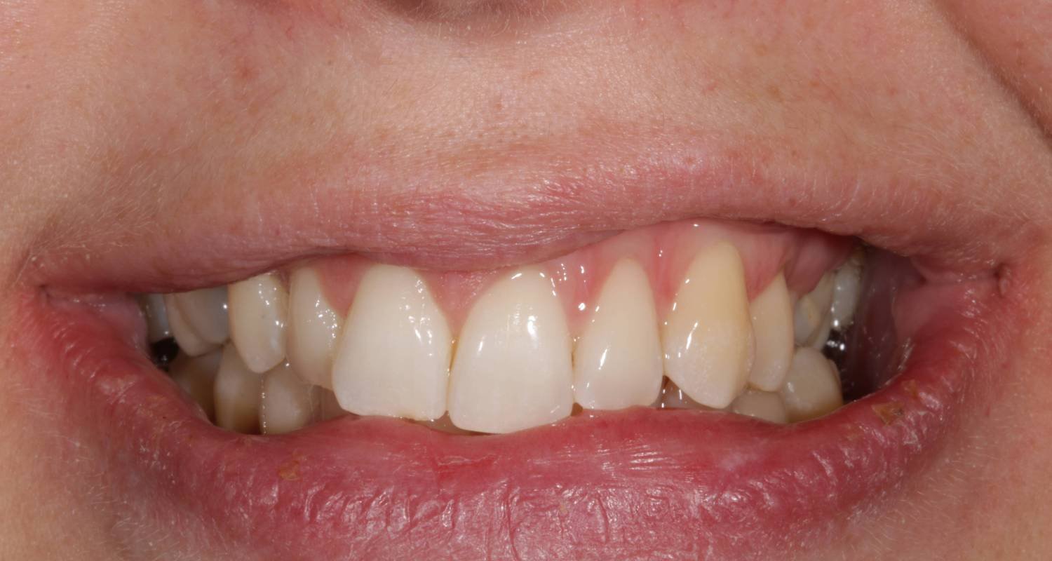 invisalign for crooked teeth before