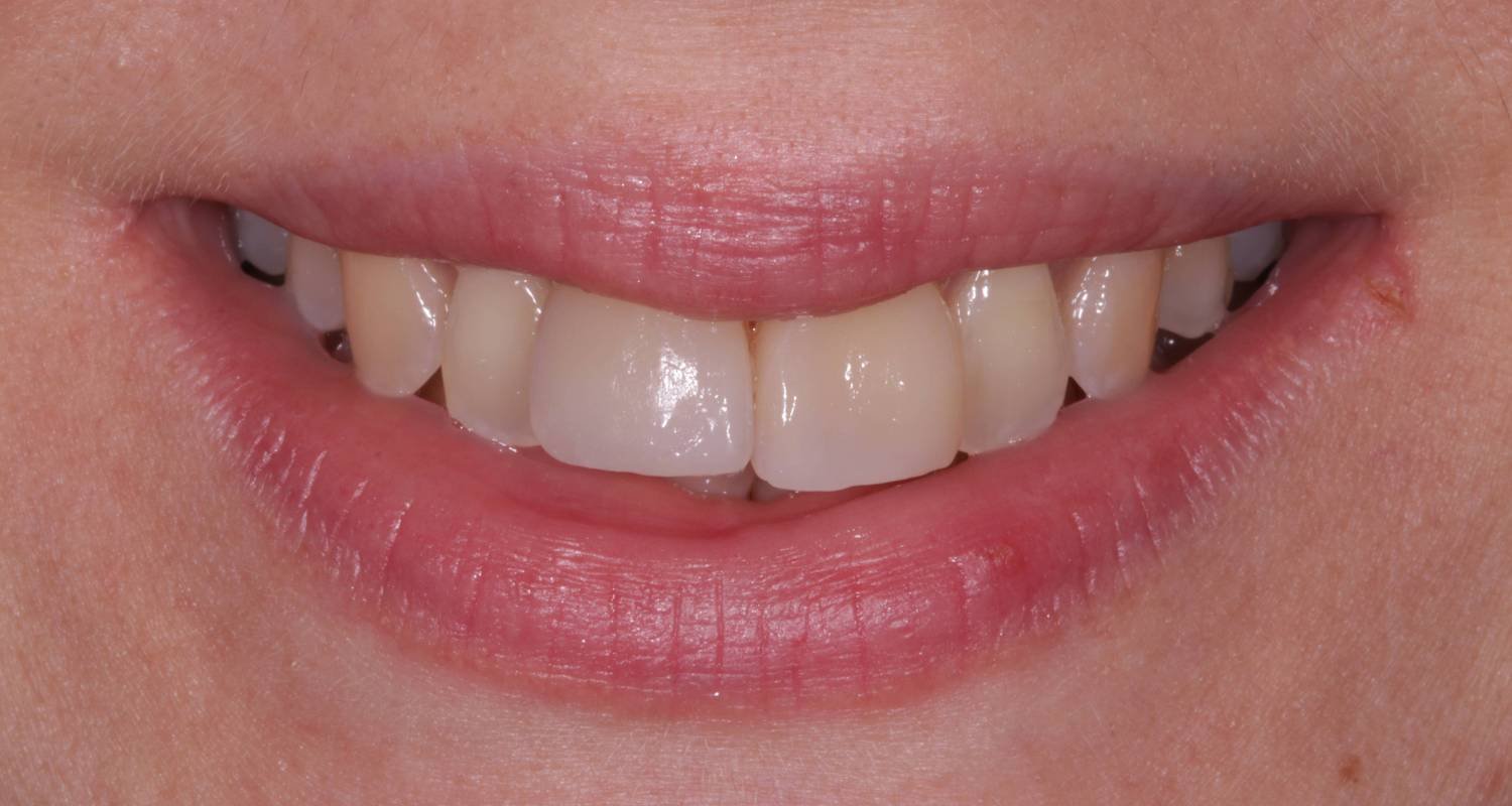 invisalign for overbite before