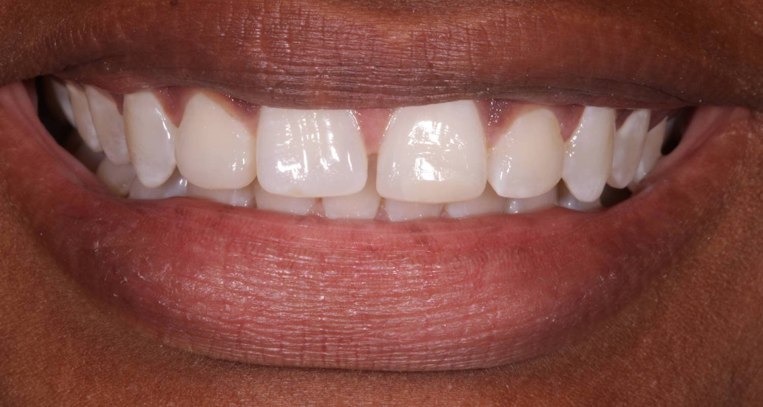 invisalign to close gap after