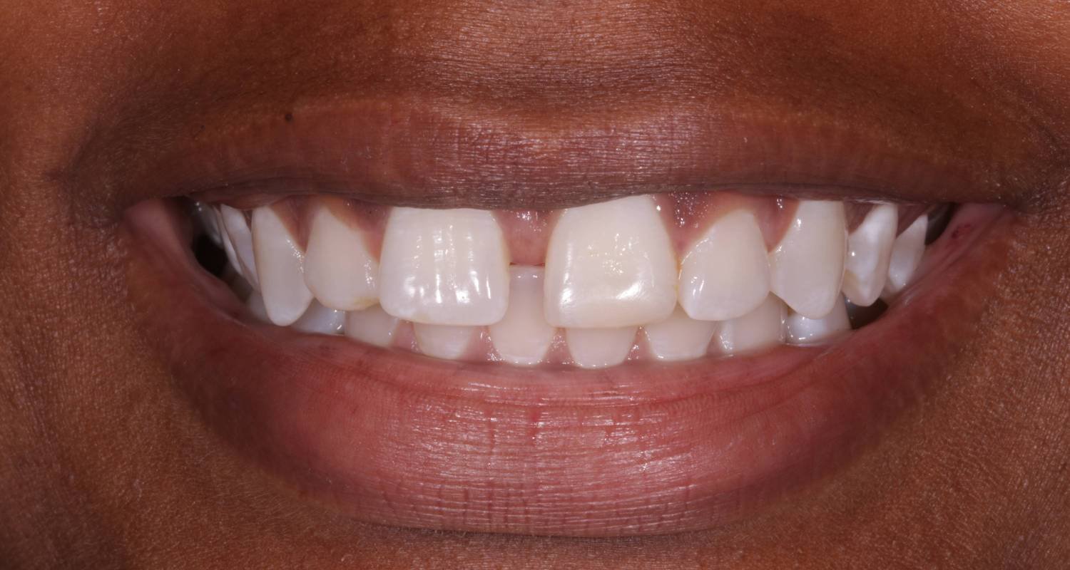 invisalign to close gap before