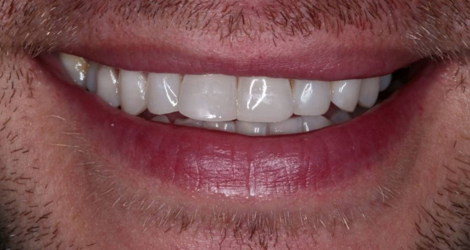 patient after bonding