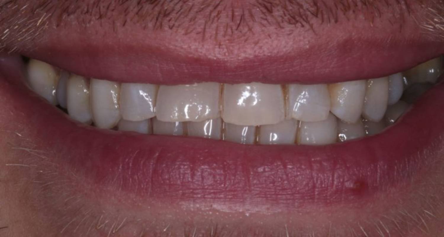 patient before bonding