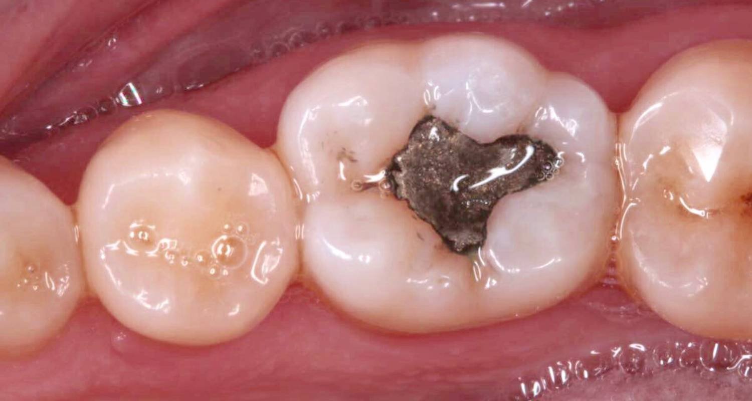 replacement filling image