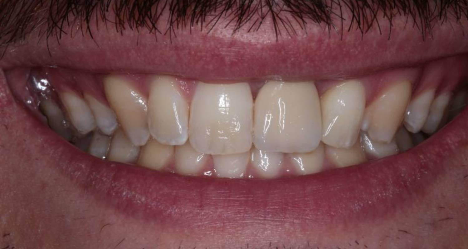 replacement implant after image