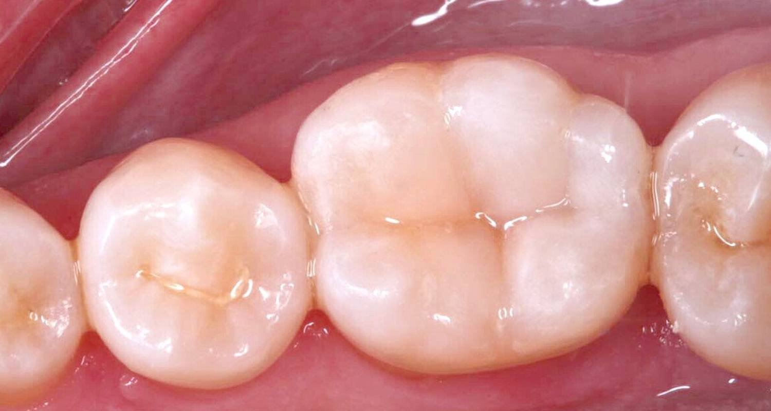 replacement white filling image