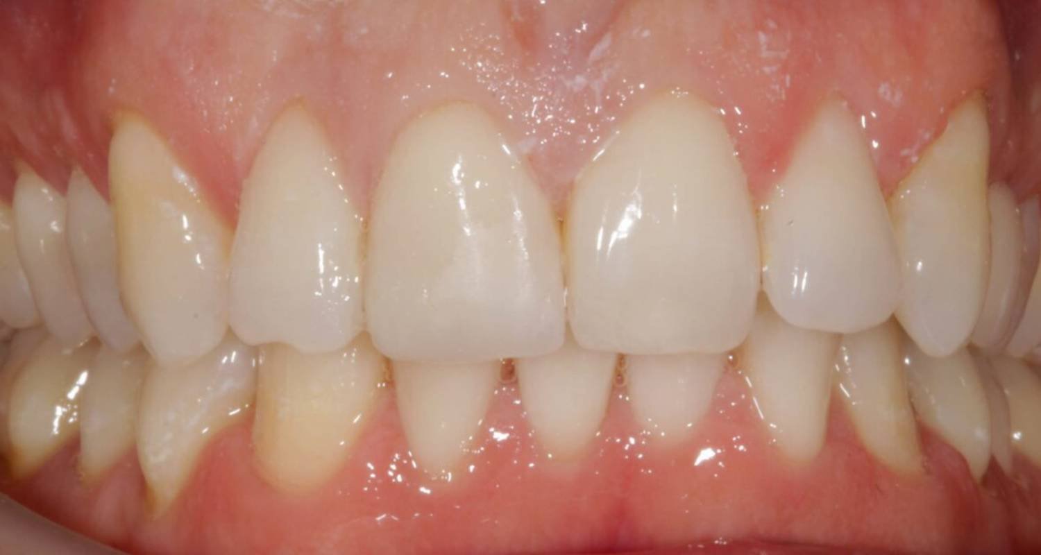 teeth reshaped after bonding