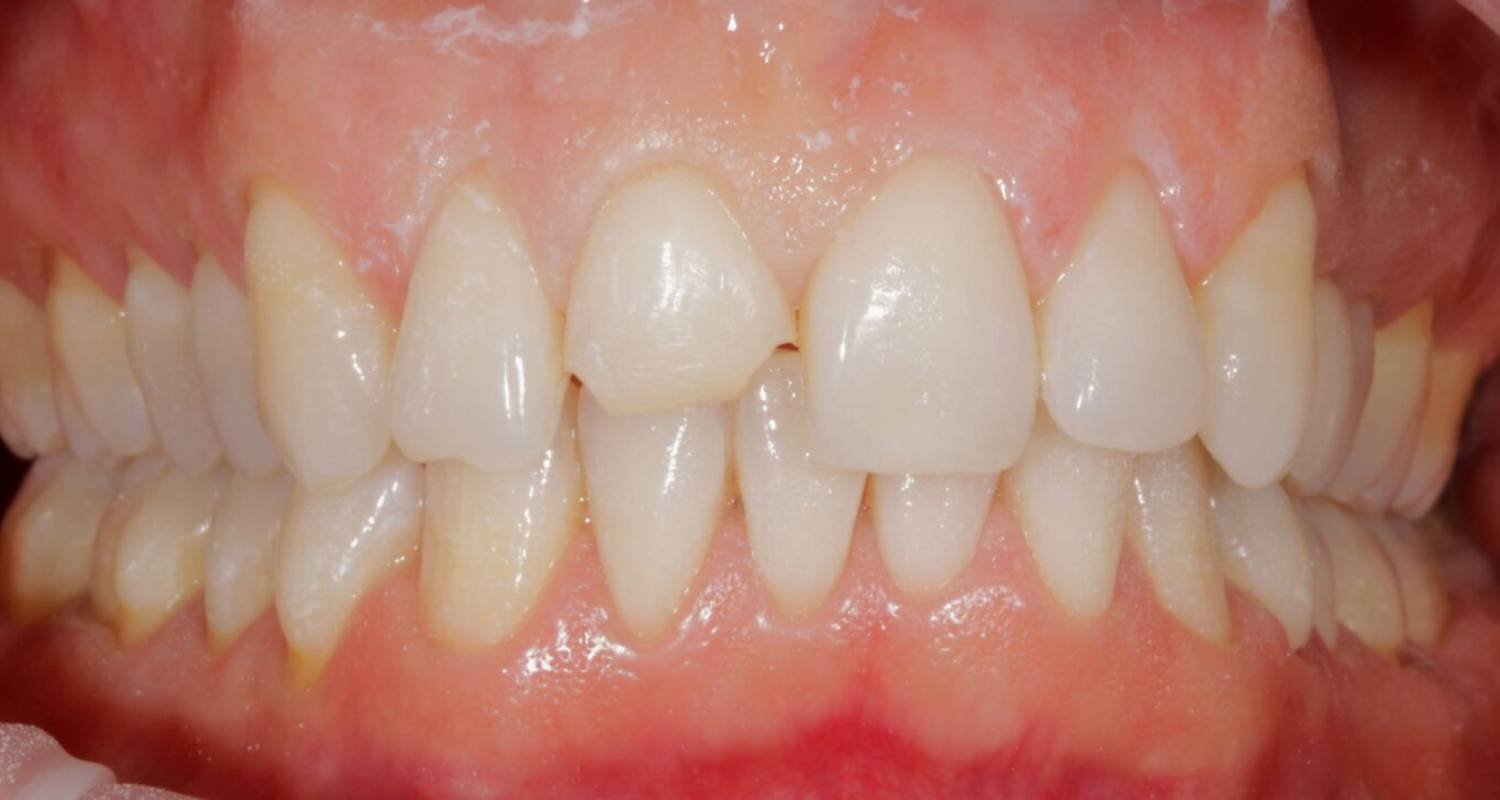 teeth reshaped before bonding
