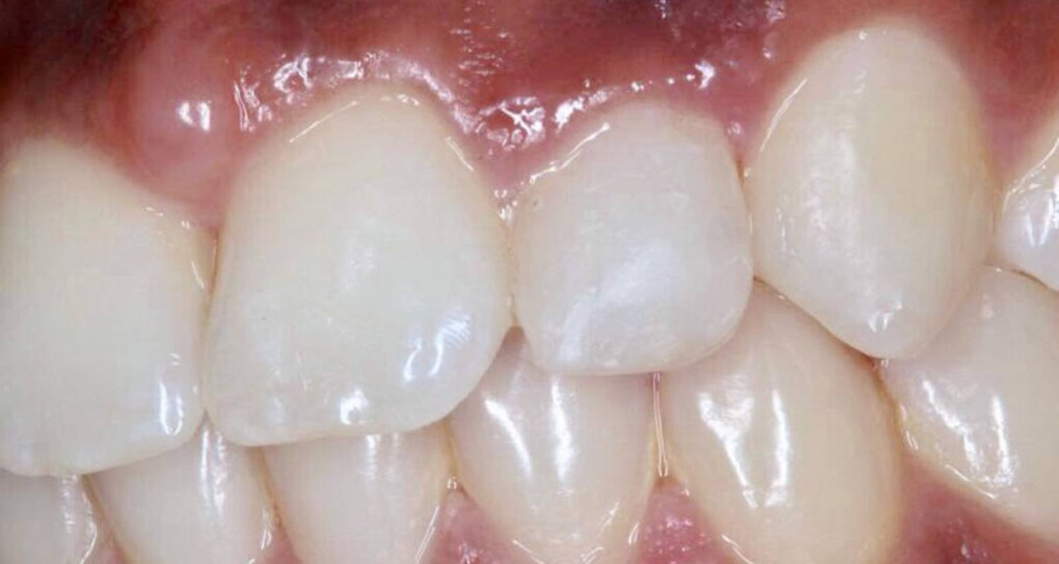 tooth after bonding