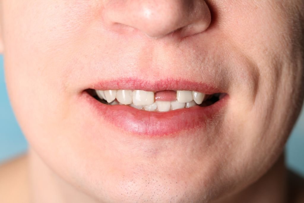 front tooth knocked out image