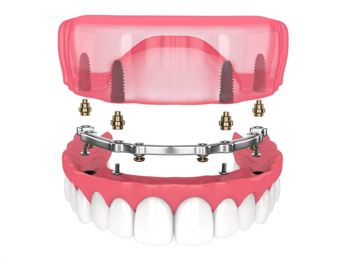 implant retained dentures