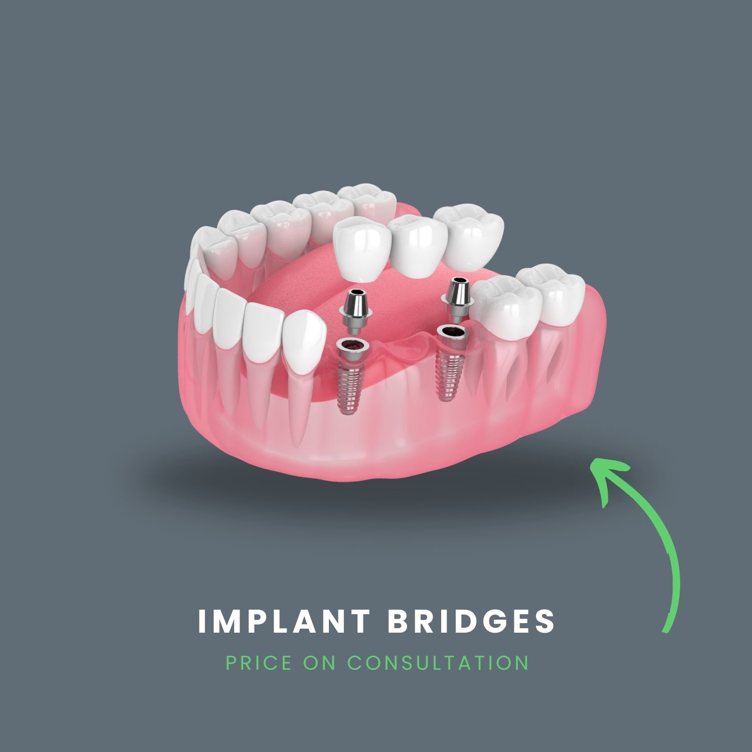 implant bridge render