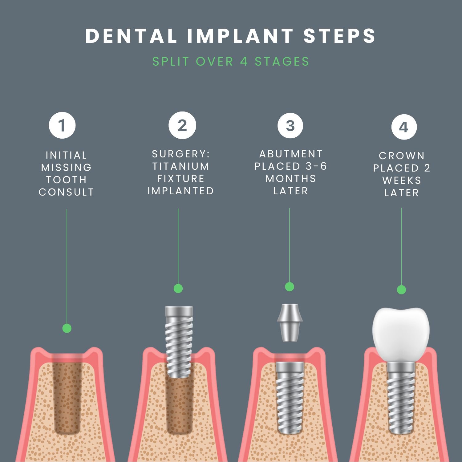 dental implant steps