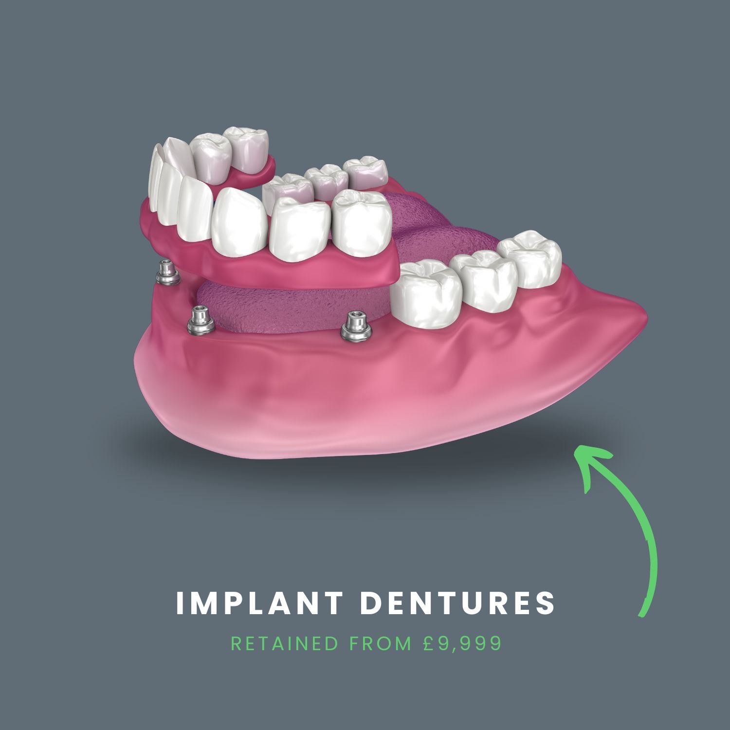 implant denture illustration