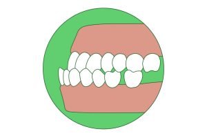 what is an underbite