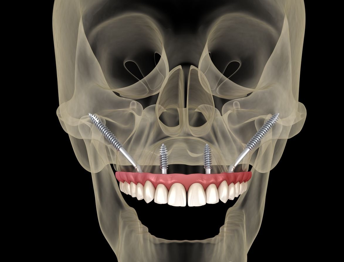 zygomatic implants