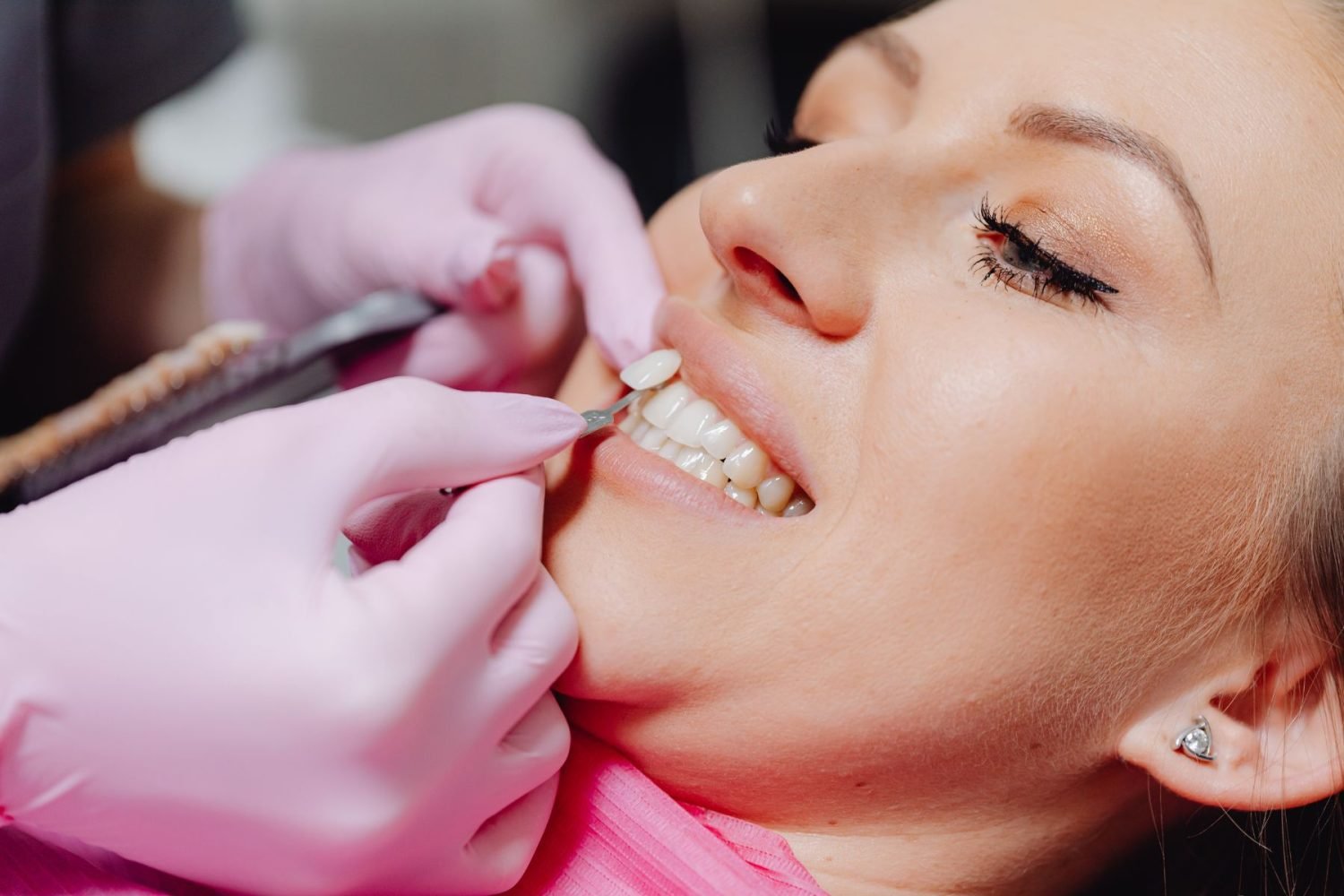 How Long Do Composite Veneers Last?