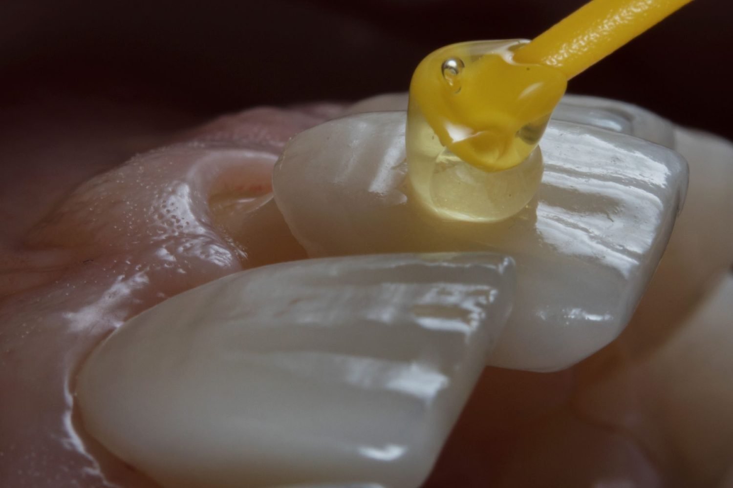 porcelain veneer photo