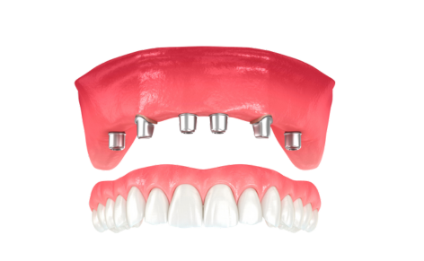 all on 4 implant illustration