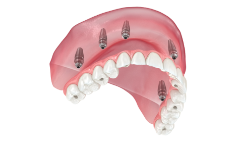 implant denture illustration