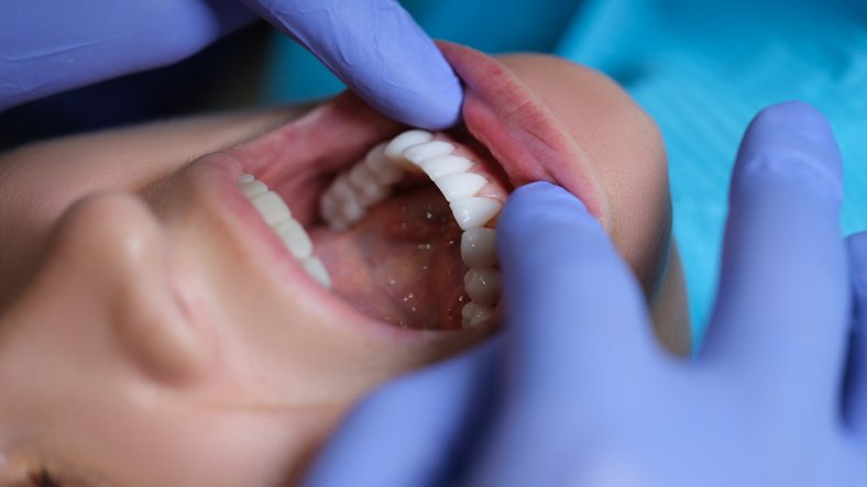 dental veneers image