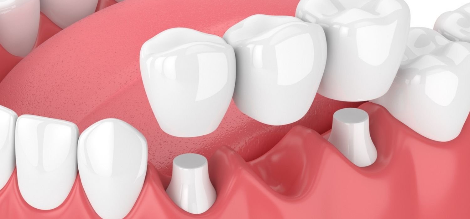 dental bridge image