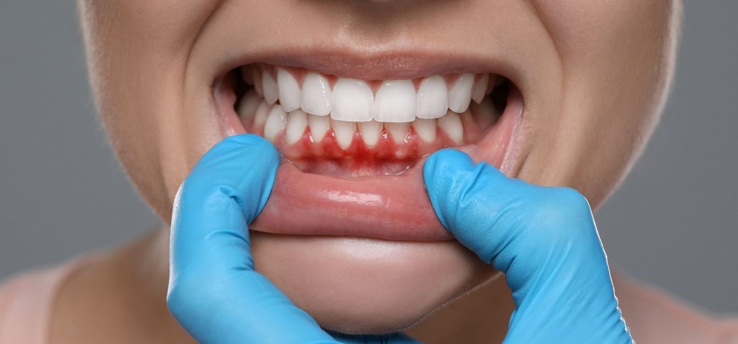 gum disease inflammed gums image